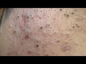 Extreme Blackhead Removal Compilation 😱