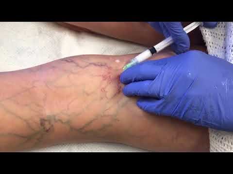 Watch This Vein Disappear - Sclerotherapy Vein Removal