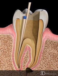 A human tooth is made up of a crown, neck and root. The crown is the outer part which is visible above the gum or gingiva; the neck is the region at the gum line between the crown and the root; and the root is the region below and within the gum. The root canal system extends down from the crown of the tooth to the end of the root, containing the dental pulp. The pulp is the central chamber of the tooth, and is made up of soft tissue, nerves and blood vessels. These vessels gain access to the pu