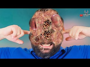 ASMR Animation treatment from infected face | ASMR Treatment Animation | 2D Animation Deep Cleaning