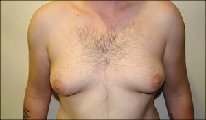 Gynecomastia NZ