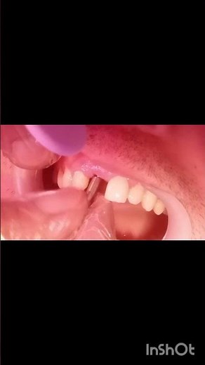 Dental Implant Surgery – Implant Placement and Healing Cap Installation