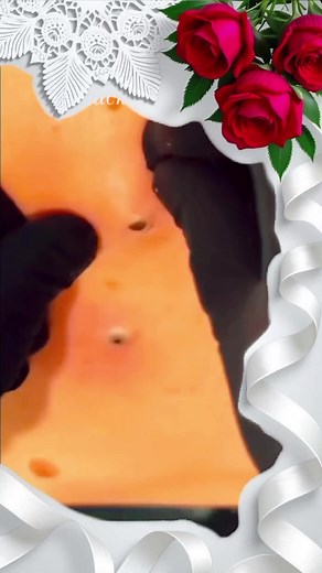 Pimple Popping ASMR: Satisfying Blackhead Extraction