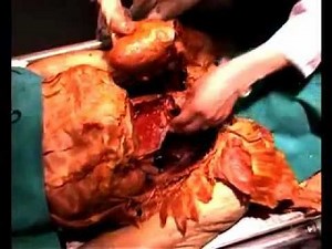 Heart and Lungs -A complete overview