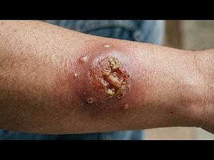 Verminous Abscess Drainage Tutorial