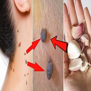 540K views · 8.5K reactions | Remove skin tags in 1 night | Amazing Skin Tag Removal Remedies | How to remove skin tags. | Health Zone | Facebook
