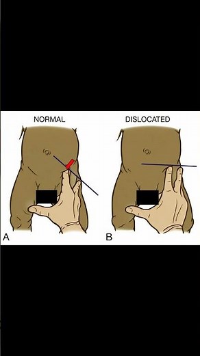 Klisic Test 🦴 Pediatric Hip Exam for DDH #pediatrics #hippain #ATC #meded #physicalexam #ortho