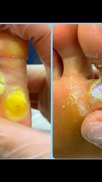 (72)Two plantar viral wart lesions