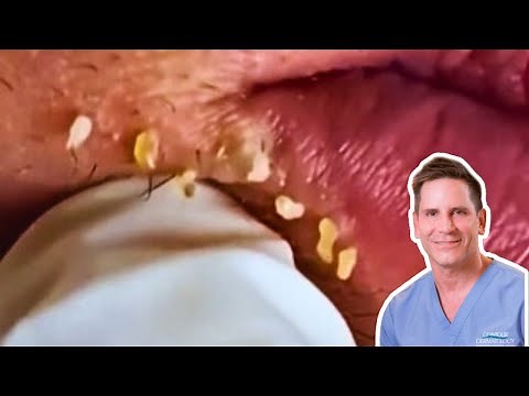 Blackheads around lips exctraction
