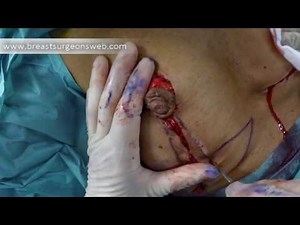 Oncoplastic Reduction Mammoplasty. Step by Step