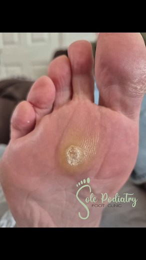Deep Corn Removal Before and After 👣✨️#podiatry #podiatrist #corn #helomadurum | Sole Podiatry