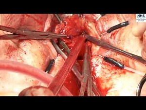 #23186 Trans-Obturator Tape Removal; vaginal and groin dissection