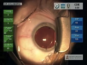 Centurion Vision System With AcrySof IQ Aspheric Toric IOL Implantation - Eyetube