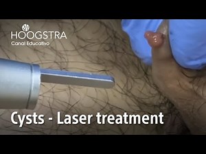 Cysts - Laser treatment - 22203