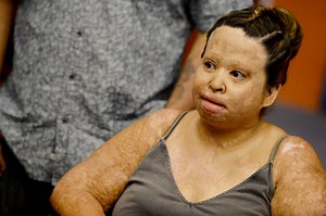 California couple’s burn scars and regret show dangers of extracting honey oil from marijuana