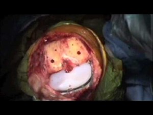 Total Knee Replacement Surgery using Patient Specific Implants - Part 2: Tibial • Video • MEDtube.net