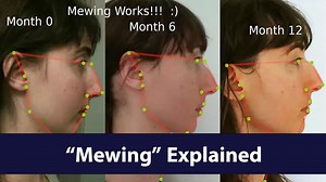 What Is Mewing? The Looksmaxxing Buzzword Explained