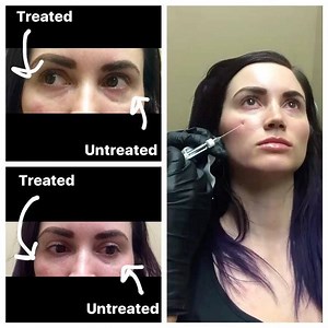 #Restylane for under-eye hollowing by @elizsheiner  She uses a cannula to minimize bruising and swelling and the best part is...the results are instant! | Utah Facial Plastics | Facebook