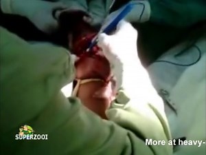 Emergency Hand Amputation