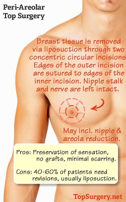 Peri-areolar Top Surgery