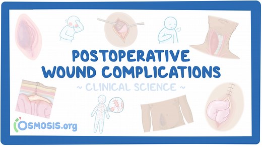 Approach to postoperative wound complications: Video & Meaning | Osmosis