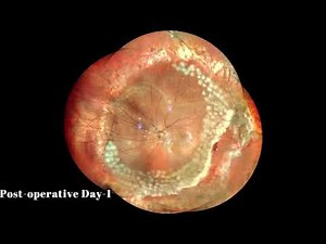 Vitrectomy for Epiretinal Membrane Removal | Macular Pucker | Dr Manish Nagpal