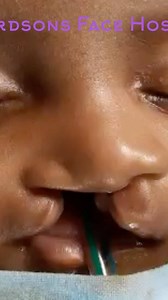 Cleft lip repair with modified millards technique - No obvious scar, tubercle created, Philtral ridge created and scar places there, so inconspicuous. #plasticsurgery #cleftlip #drsunilrichardson #musclerepair #finesse #changingfaces #changinglives | Richardsons Dental & Craniofacial Hospital