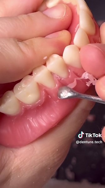 Streamlining Denture Creation with Wax Details