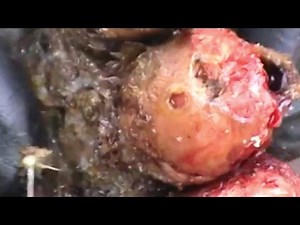 Luka's Jiggers Dug Out! Jigger Removal