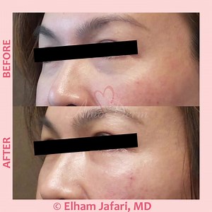  4D Under Eye Lift™ as part of non-surgical facelift (Liquid...