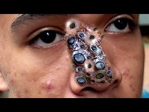 plucking Facial Huge HAIR Remove ASMR