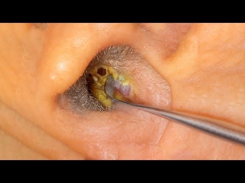 Thick Ear Wax Removed Under Endoscope View