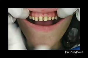 Trial Smile ⚠️ to show the patient what his/her permanent veneers will look like. Before placing veneers it is important to show you what your new smile will look like in order to allow you to get used to ur new smile and make sure u are 100% certain this is the perfect smile for u. | Smile To Smile Dental Clinics | Facebook