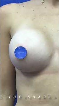 Breast Augmentation by Dr. William - Before and After