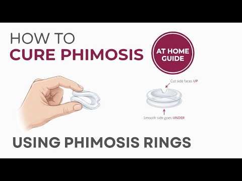 [Safe & Fast] How to Cure Phimosis at Home: The Complete Vajraang Ring Guide