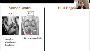 Workup and Outcomes for an Acute PLC Case (case-based)