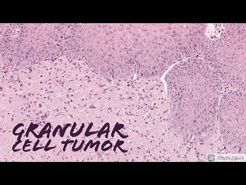 Granular Cell Tumor: 5-Minute Pathology Pearls