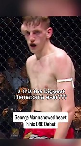 He's growing a second head?! 🤯 What you're actually looking at: Auricular Hematoma When blunt force trauma compresses the ear or temple region against the skull, blood vessels rupture between the skin and cartilage. Without proper drainage, this collection of blood can permanently damage the underlying structure. As a ringside physician, my job is to assess whether a fighter can safely continue—and when an injury like this requires immediate intervention. Left untreated, hematomas can lead to t