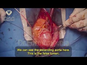 Aortic Dissection Type A Repair – Supracoronary Ascending Aorta Replacement Tutorial