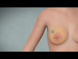 Understanding skin-sparing and nipple-sparing mastectomies