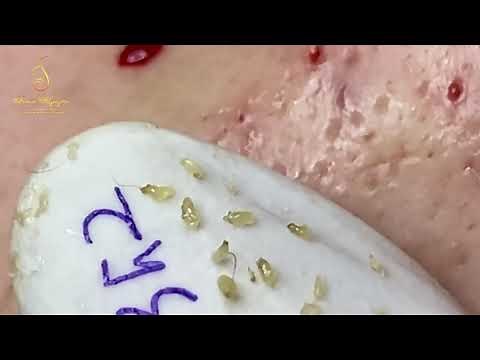 A lot of blackheads on the female client's face (352a) | Loan Nguyen