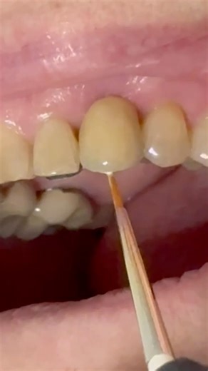 Applying Lifelike Shade Colors! Join our YouTube Membership or Patreon to see more! YouTube.com/LSK121 Patreon.com/LukeKahng #dental #dentaltechnology #dentaltechnician #dentaltech #dentist #lukekahng #lsk121 #lsk121oralprothetics | Luke Kahng
