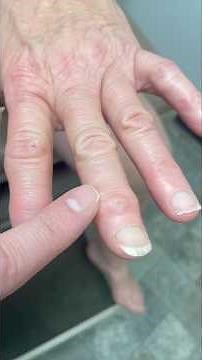 Small joint arthritis of fingers – Heberden and Bouchard nodules￼