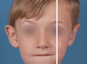 As a pediatric plastic surgeon, a common procedure I perform is an...