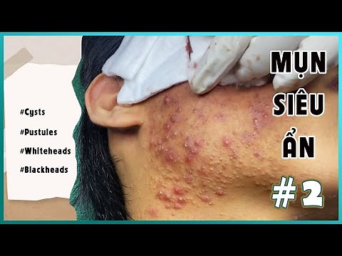 Big Cystic Acne Blackheads Extraction Blackheads & Milia, Whiteheads Removal Pimple Popping