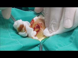 Apse Kasıkta - Abscess İnguinal region