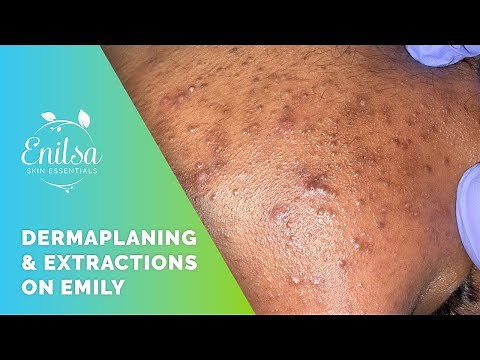 Light Dermaplaning + Blackhead Extractions on Emily