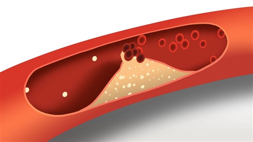 1.7K views · 25 reactions | Did you know that not all cholesterol is ‘bad’? Your body needs some cholesterol to work properly. But, if the amount of bad cholesterol in the blood gets too high, it can cause a heart attack or stroke. Find out how high cholesterol can affect your heart and what you can do to lower it. https://bit.ly/3oFjNty | Heart Foundation NZ | Facebook