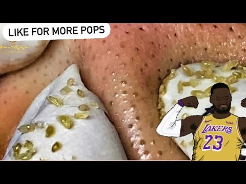 Best Pops of April 2022! Pimples, Acne and Blackheads