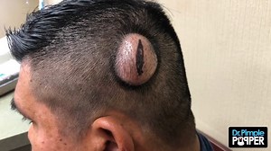 Sandra Lee, MD, FAAD, FAACS | Start your week off right! Here’s a GIANT PILAR cyst for the Monday motivation! 💥 #drpimplepopper | Instagram